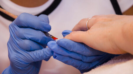 Nail fungal infection – Causes, symptoms, and management